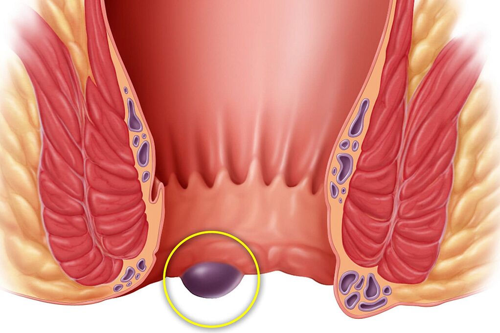 Hemorrhoids
